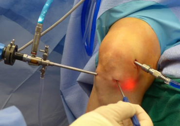 Una técnica quirúrgica pionera en España repara el ligamento cruzado anterior con tejido propio – Expansión newspaper, 27th April 2015